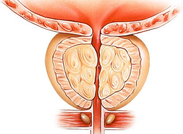 inflamed prostate illustration